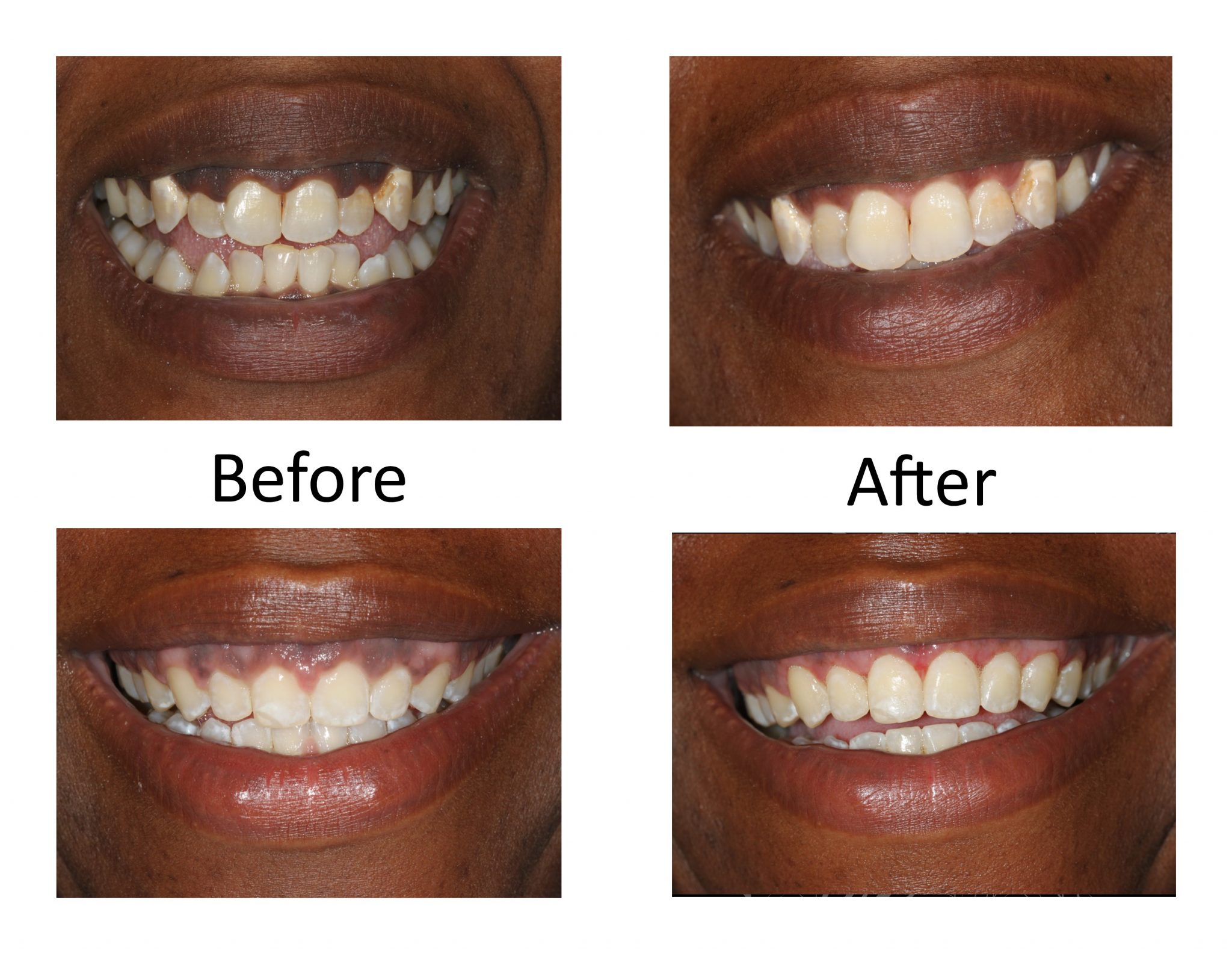 Before And After Lake Forest Dental